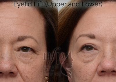 Before and After Eyelid Lift