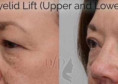 Before and after eyelid lift