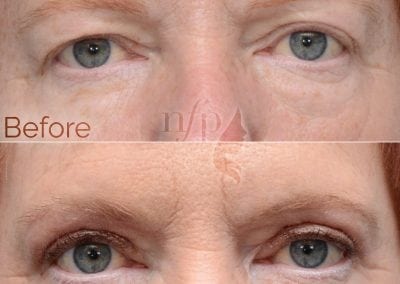 Before and After Eyelid Lift