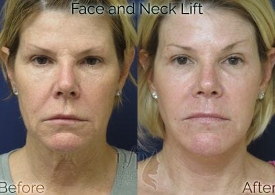 before and after face neck lift facelift