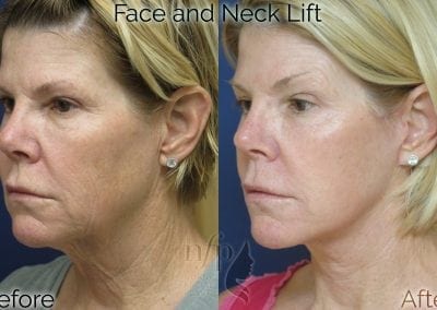 before and after face neck lift facelift