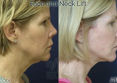 before and after face neck lift facelift