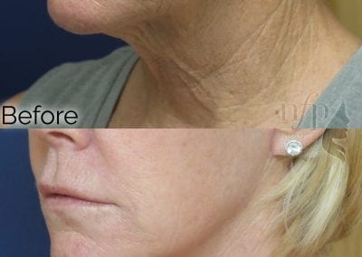 before and after face neck lift facelift