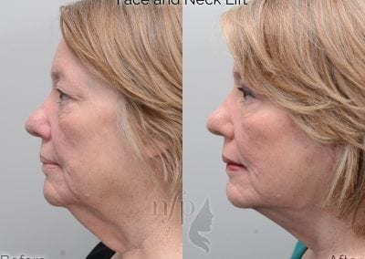 before and after face neck lift facelift