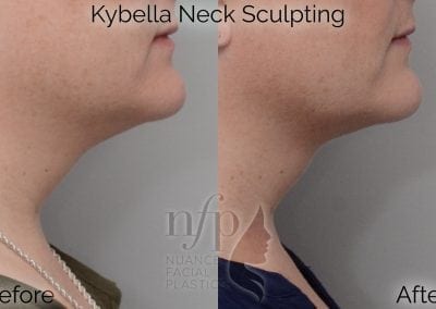 Before and After Kybella