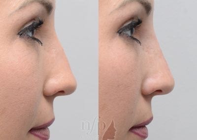 Before and After non surgical rhinoplasty