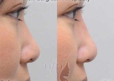 Before and After Non Surgical Rhinoplasty