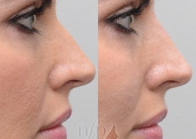 before and after non surgical rhinoplasty