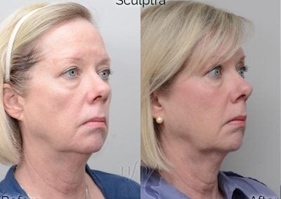 before and after sculptra