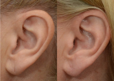 elongated earlobe repair patient