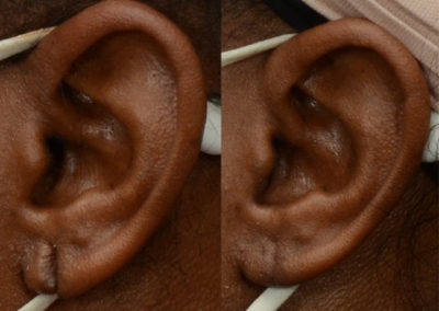 Patient before and after repair of her torn earlobe