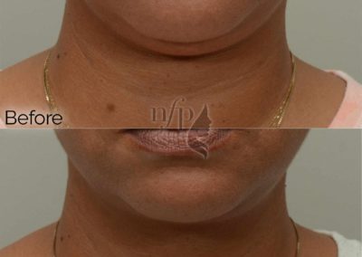 Patient before and after double chin liposuction, front view